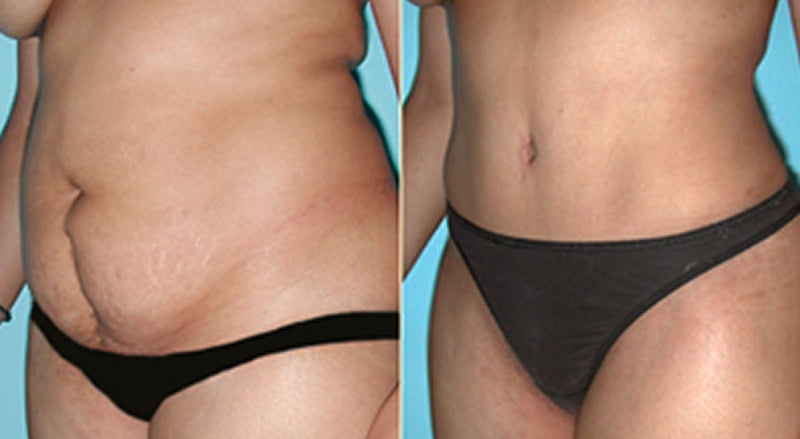 🔥 Cuida tu piel y realza tu silueta con cada aplicación, LipoGel Plus🔥